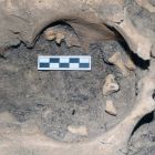 Des dents poussent dans ses ovaires... et sont découvertes 3000 ans plus tard